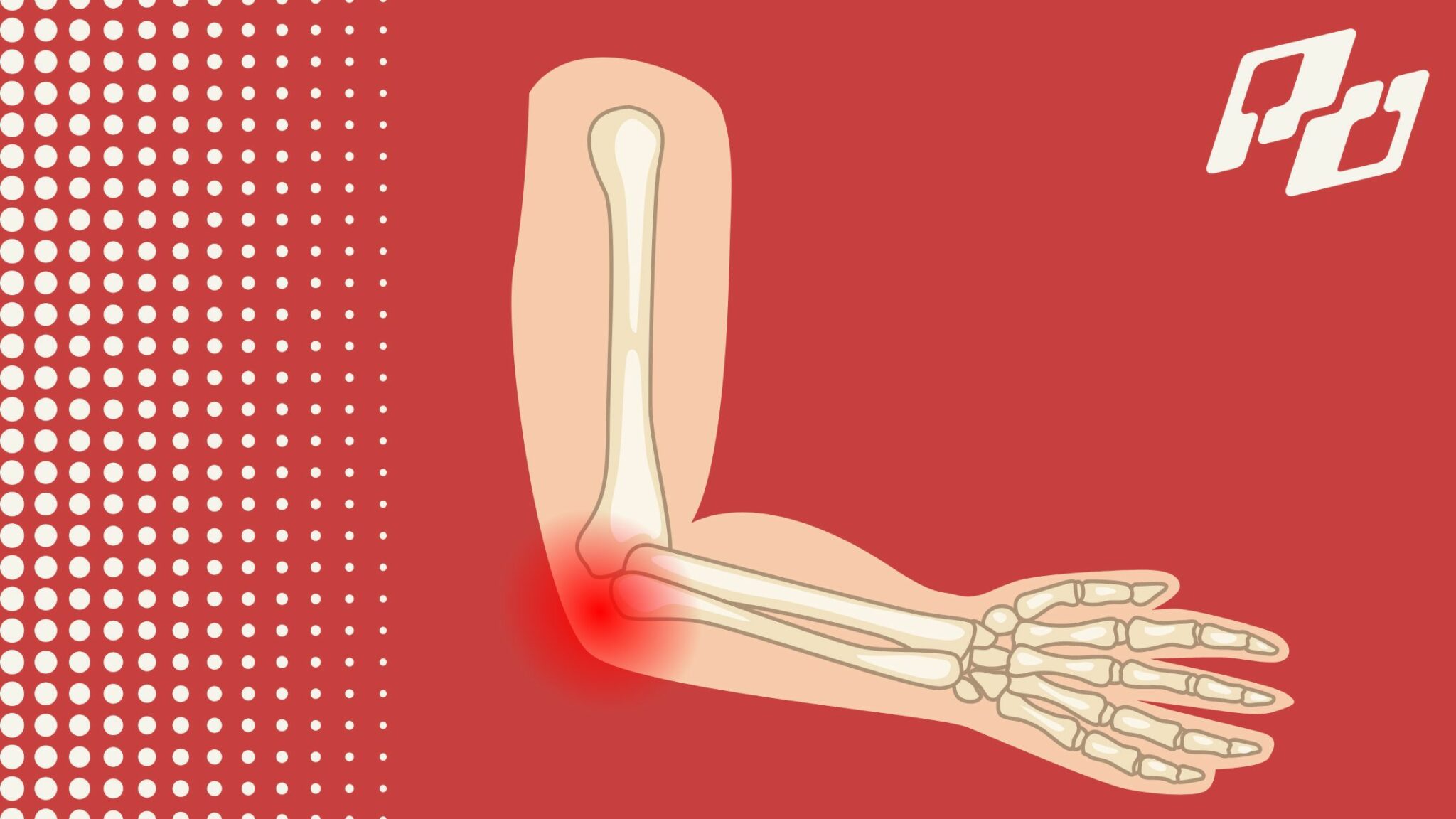 Elbow Pain on the Court It Could Be Pickleball Elbow