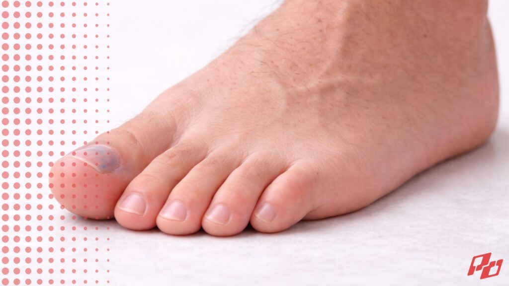 Why Your Toenail Keeps Turning Black From Pickleball(1)